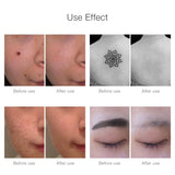 Tattoo Scar Mole Freckle Laser Removar - fitople